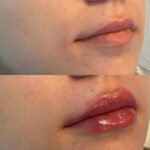 resultado joao labios
